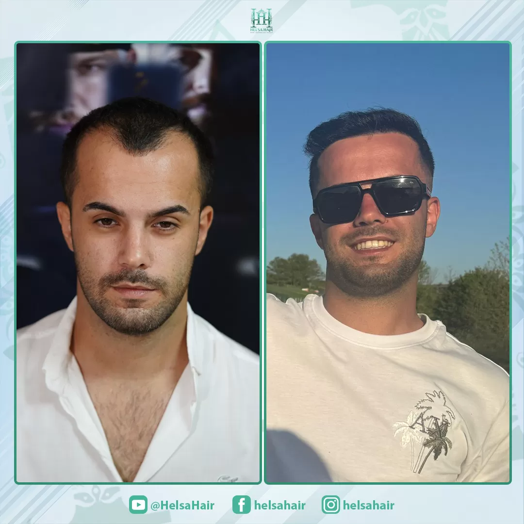 Saç Ekim Sonucu 2
