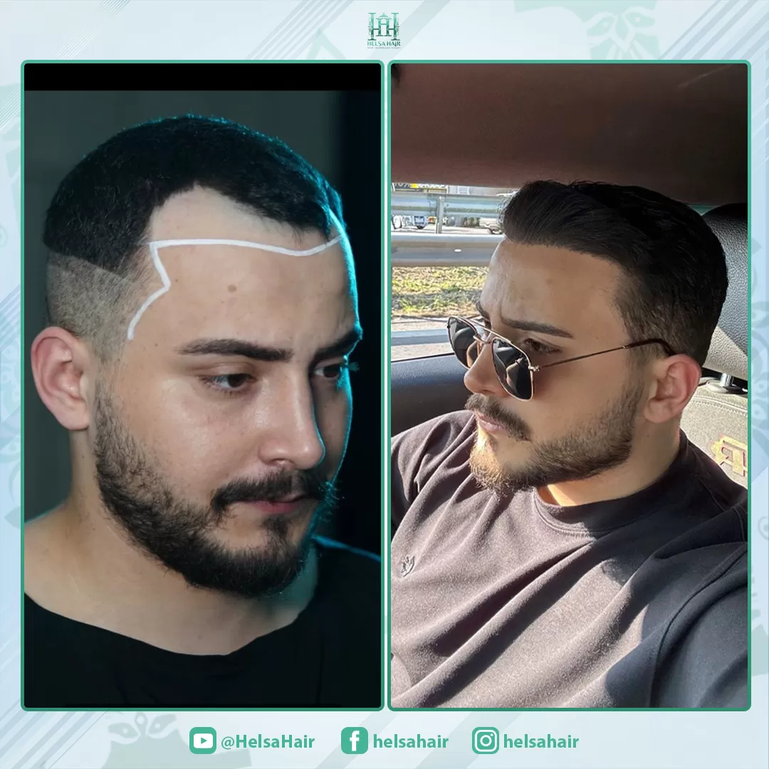 Saç Ekim Sonucu 1