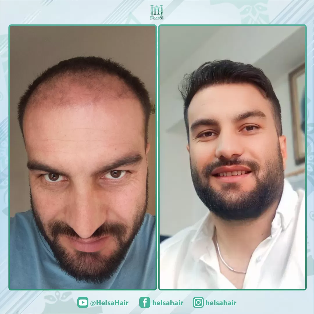 Saç Ekim Sonucu 4