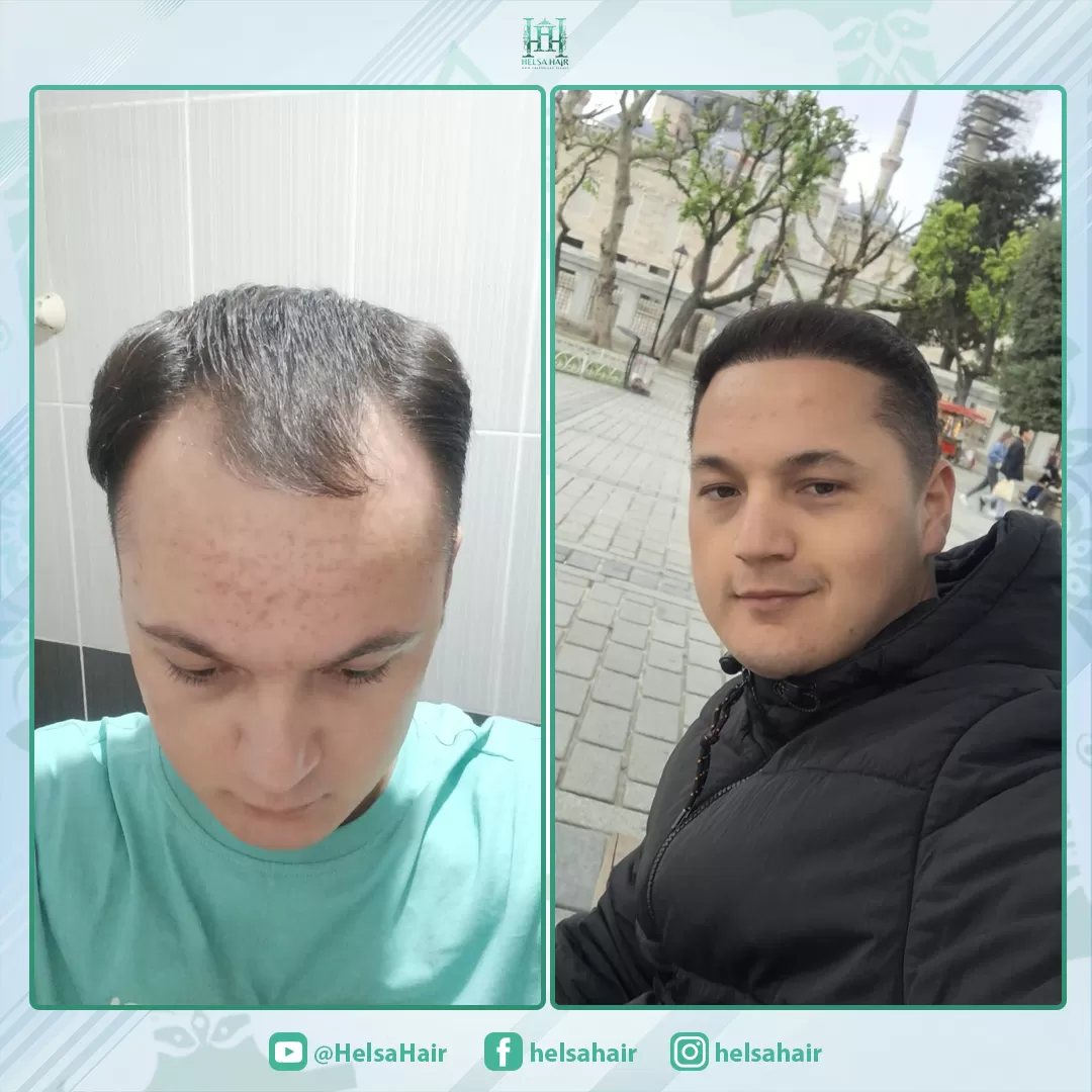Saç Ekimi Sonucu 2