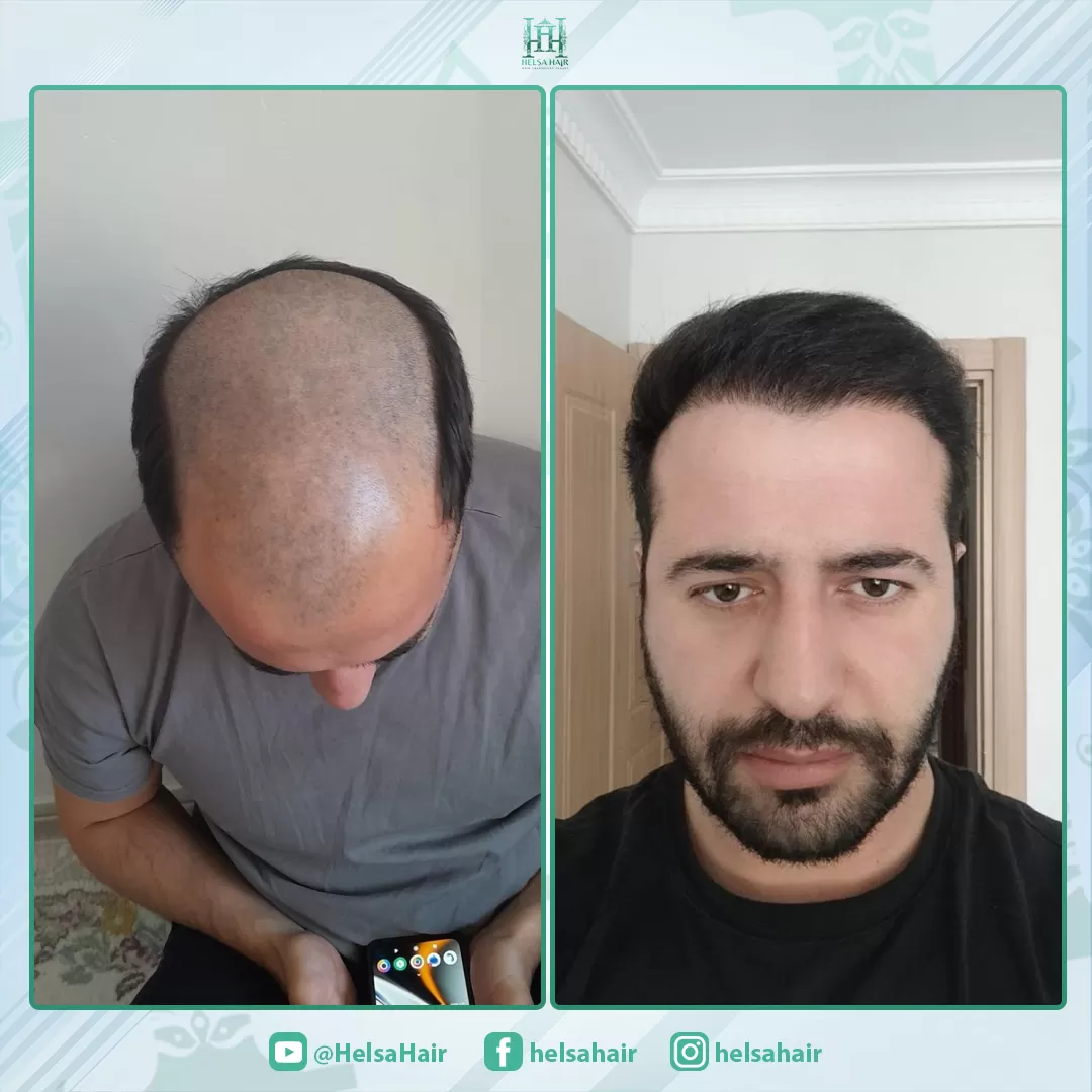Saç Ekimi Sonucu 4