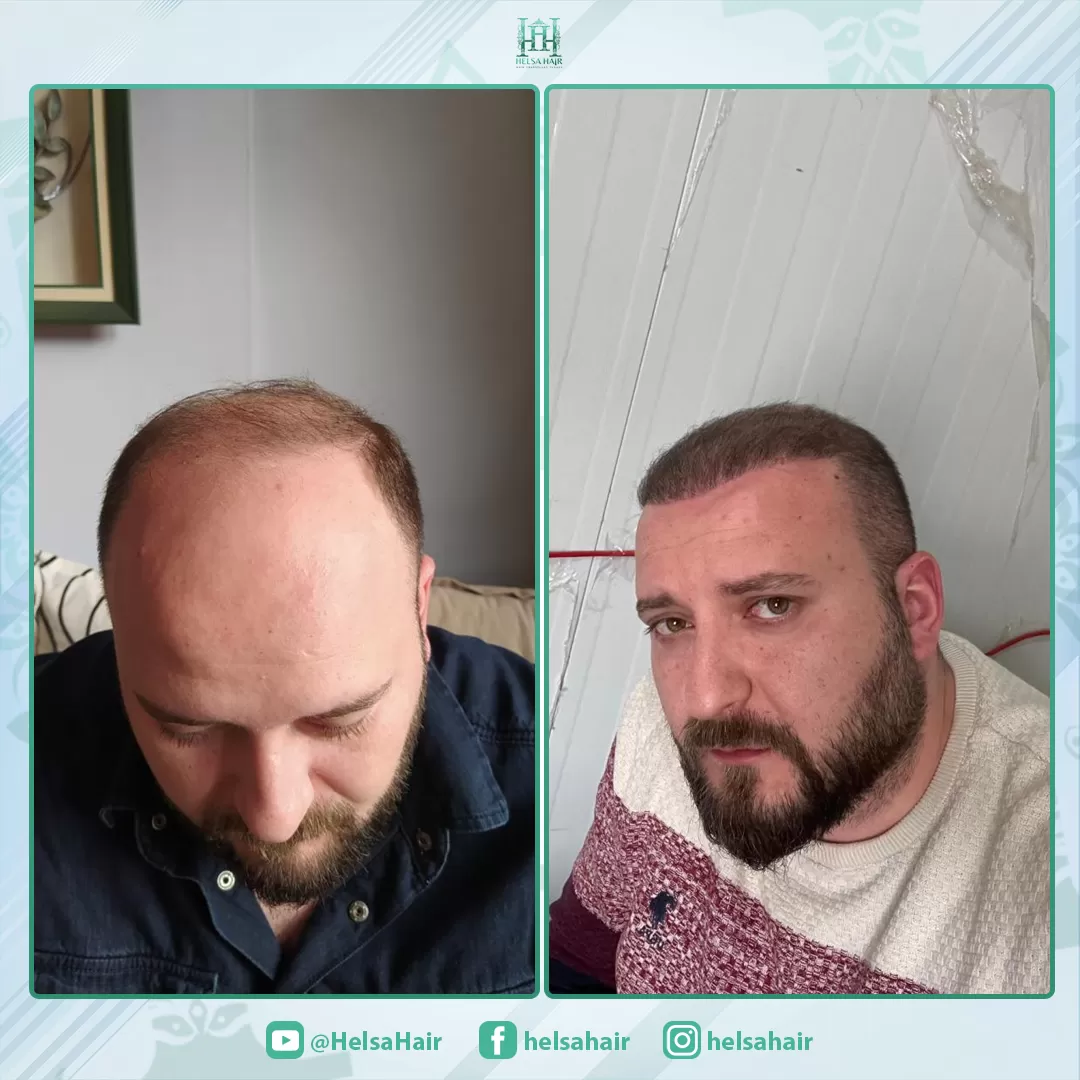 Saç Ekimi Sonucu 1