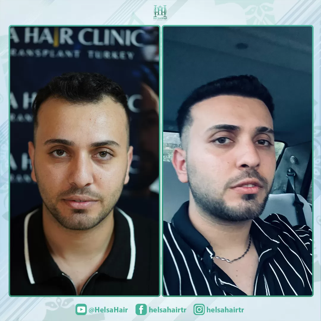 Saç Ekimi Öncesi ve Sonrası