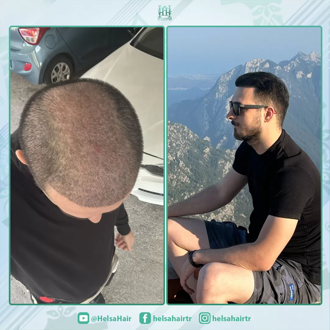 Saç Ekimi Öncesi ve Sonrası