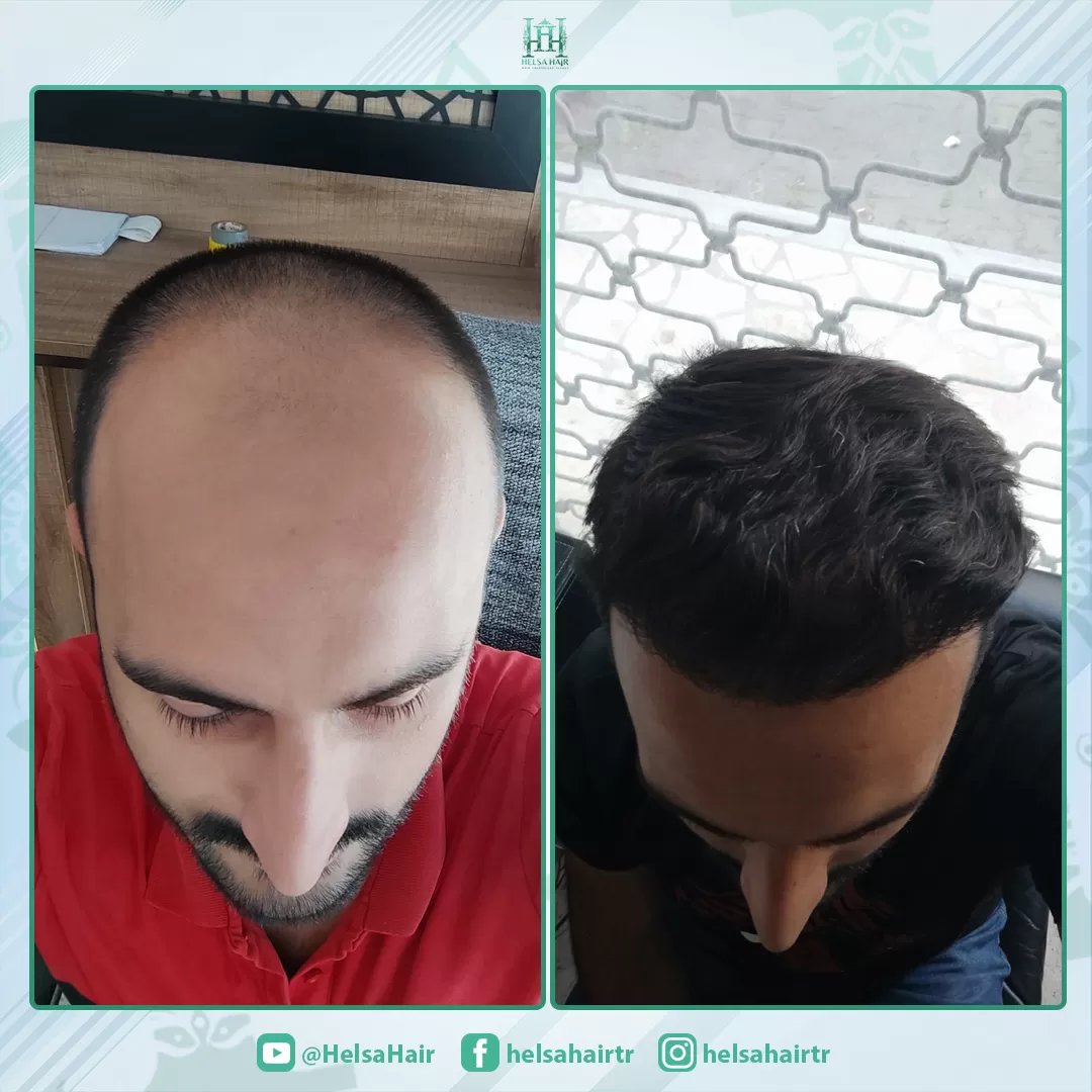 Saç Ekimi Sonucu 1