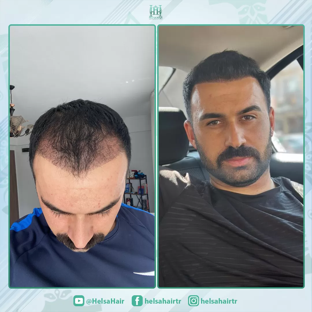 Saç Ekimi Sonucu 2