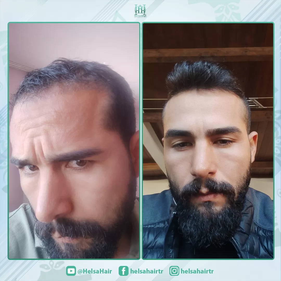 Saç Ekimi Sonucu 3