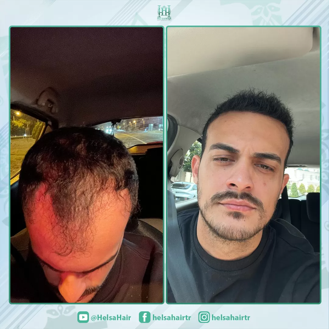 Saç Ekimi Öncesi ve Sonrası
