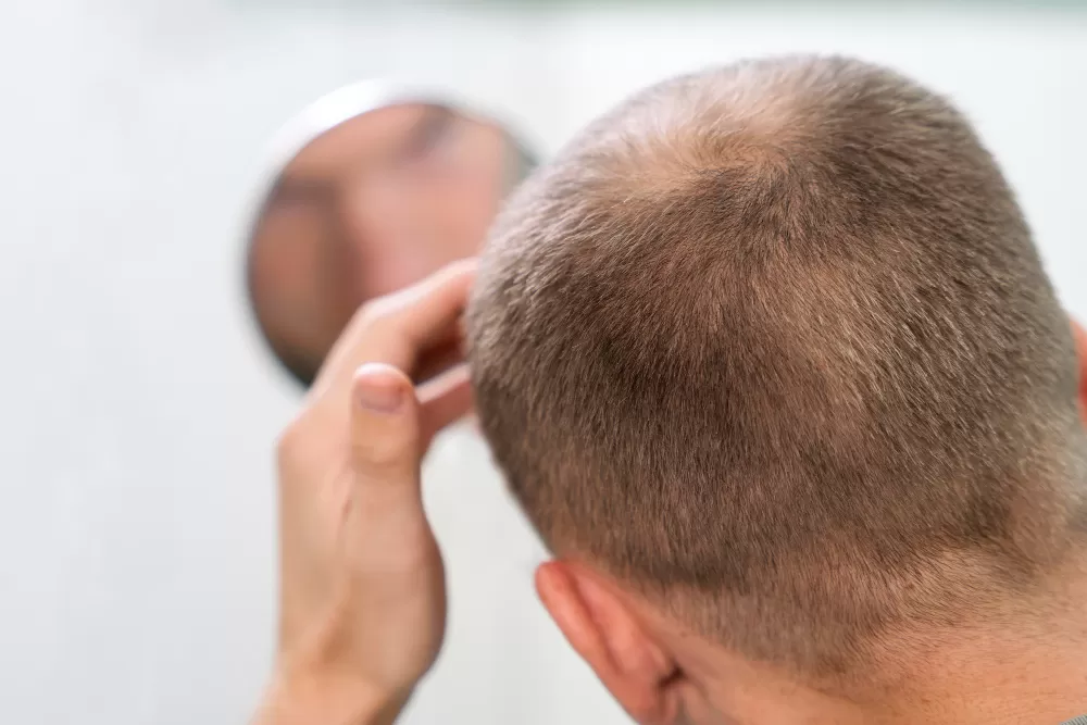 Hair Transplant Recovery Process