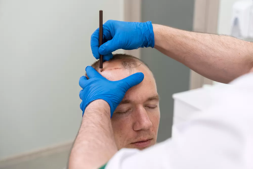 If the First Hair Transplant Failed: What Is a Revision Hair Transplant?